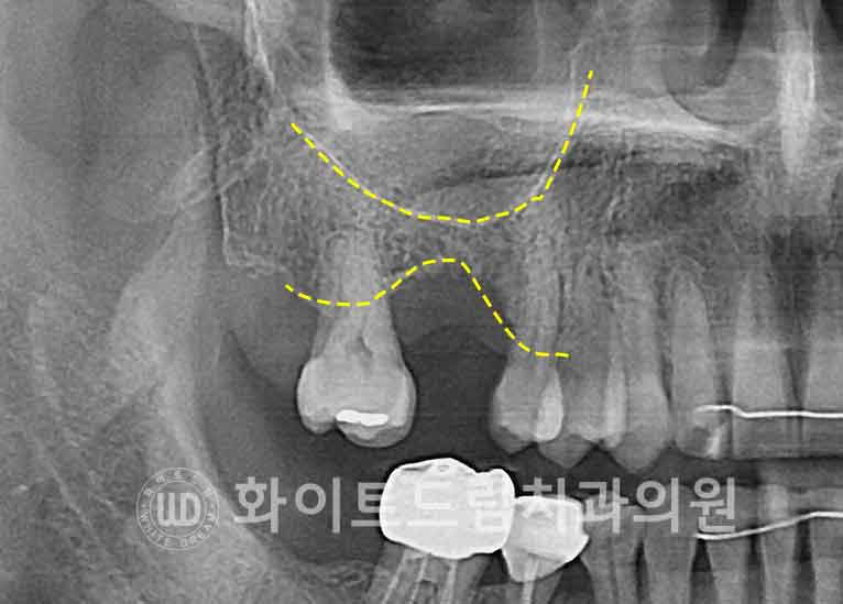 강남역어금니임플란트 치료 시 흔히 동반되는 상악동거상술 (Lateral window 방식), "잘 됐는지 어떻게 확인하죠?" 관련 이미지 8