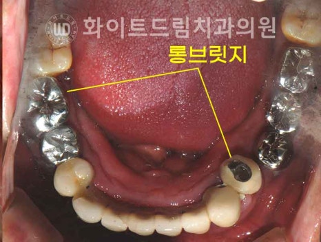 서울전체임플란트잘하는치과, 왜 치주염이 심해지면 반대교합까지 생길까요? (치주염 전체 임플란트 CASE) 관련 이미지 9