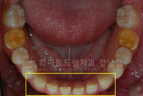 법랑질형성부전증, 라미네이트로 개선해요! / 강남역 라미네이트 치과 관련 이미지 11