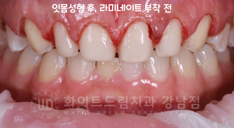 강남역 라미네이트 "치아가 작고 벌어졌어요" 거미스마일 + 벌어진 치아 개선 관련 이미지 12