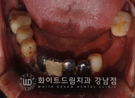 전체 임플란트 치료 기간과 내원 횟수는? "치과에 자주 가기 어려워요." 관련 이미지 7