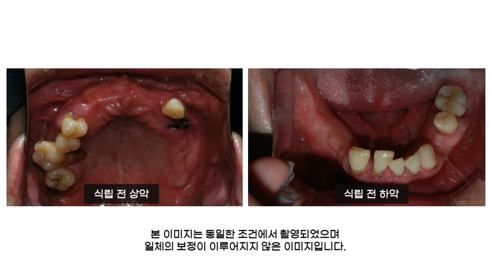 40대임플란트식립후기 및 어금니임플란트 가격, 종류 알아보기 위해 관련 이미지 3