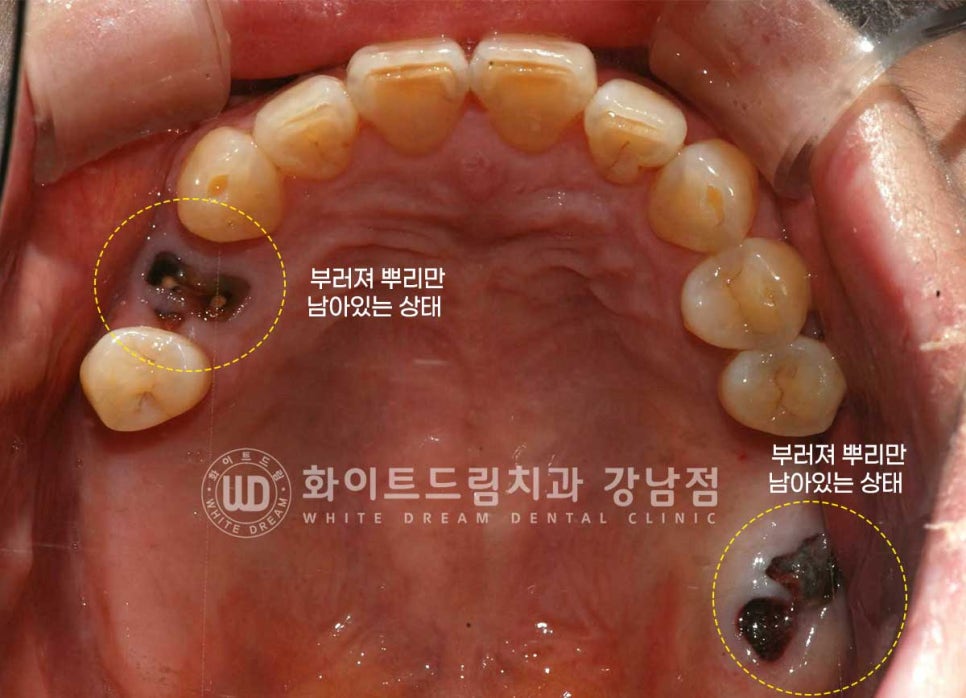 신경치료 후 크라운을 해야 하는 이유 / 크라운을 안 해 부러진 치아 임플란트 치료 case 관련 이미지 4