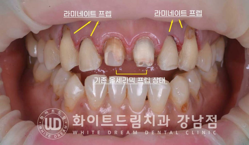 치경부착색 치료 / 라미네이트 vs 올세라믹 치아 삭제량 비교 (Feat. 라미네이트 후 치아미백 가능한가요?) 관련 이미지 8