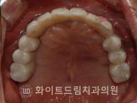 서울전체임플란트잘하는치과, 왜 치주염이 심해지면 반대교합까지 생길까요? (치주염 전체 임플란트 CASE) 관련 이미지 18