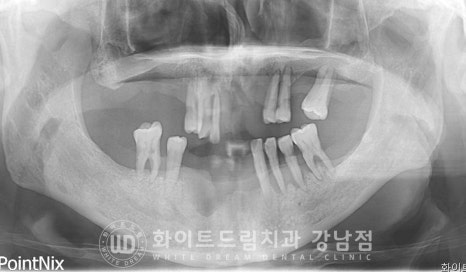 치주염 전체임플란트, 염증으로 인한 상악동 천공 & 신경관 가까이 녹은 잇몸뼈. 임플란트 식립 가능할까? 관련 이미지 14