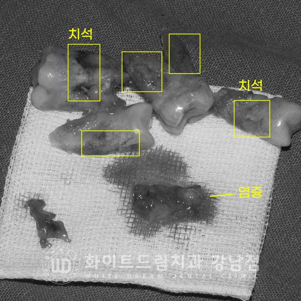 발치 즉시 임플란트 "내원 당일 발치 후 바로 임플란트 식립!" 관련 이미지 8