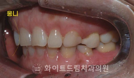 강남옹니라미네이트 "치아가 안으로 들어가서 할머니처럼 보여요" 경미 & 중증도 옹니 라미네이트 치료 관련 이미지 7