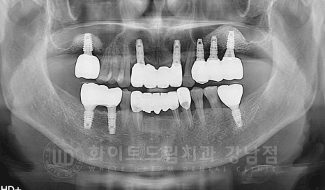 서초동 치과 추천 / "임플란트 개수를 줄이는 식립 방법은?" 강남 화이트드림치과 임플란트 관련 이미지 17