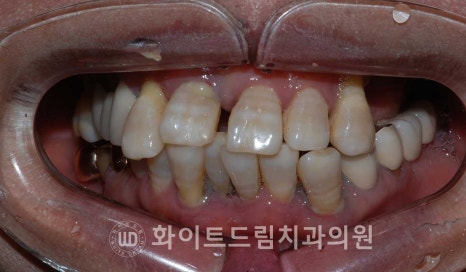 강남역전체임플란트 / 발치 후 즉시 식립, 무조건 누구나 3개월로 끝낼 수 있는 것일까? 강남역화이트드림치과 관련 이미지 3