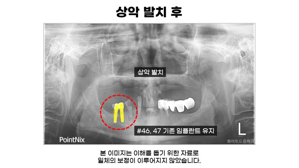 전악 임플란트 과정 및 후기 전후사례확인하고 임플란트가격 비용 알아보기 관련 이미지 2