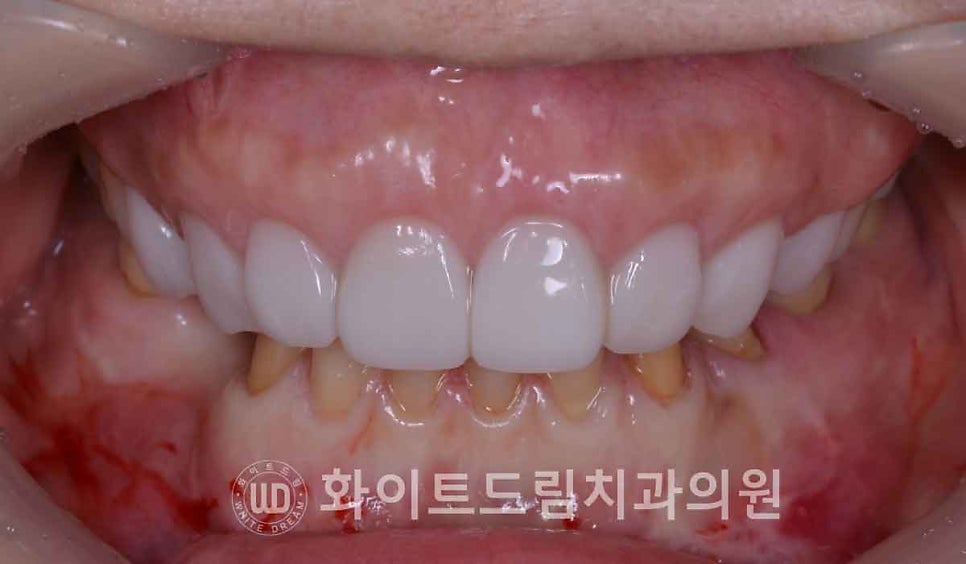 강남옹니라미네이트 "치아가 안으로 들어가서 할머니처럼 보여요" 경미 & 중증도 옹니 라미네이트 치료 관련 이미지 16