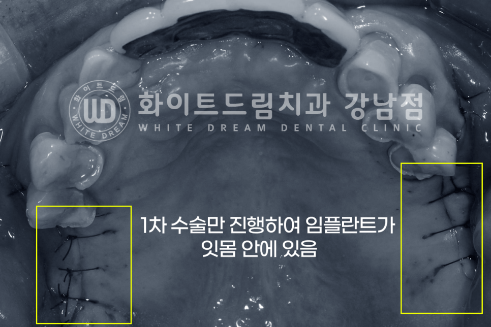 강남역 임플란트치과 / "어금니가 없고 이갈이가 심해요" 강남역 화이트드림치과 관련 이미지 5