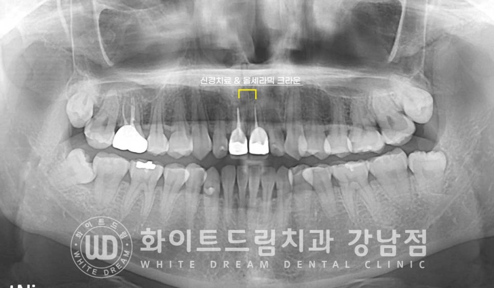 치경부착색 치료 / 라미네이트 vs 올세라믹 치아 삭제량 비교 (Feat. 라미네이트 후 치아미백 가능한가요?) 관련 이미지 5