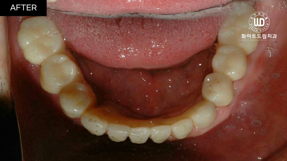 전체임플란트 식립 및 임플란트뼈이식 후기 관련 이미지 9