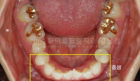 강남역 나비앞니 라미네이트 / "투명교정과 라미네이트 치료" 강남역 화이트드림치과 관련 이미지 15