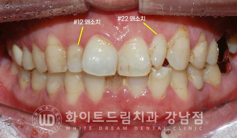 앞니 레진변색 "너무 지저분해 보여요." 라미네이트로 깔끔하게 교체한 치료 사례 관련 이미지 6