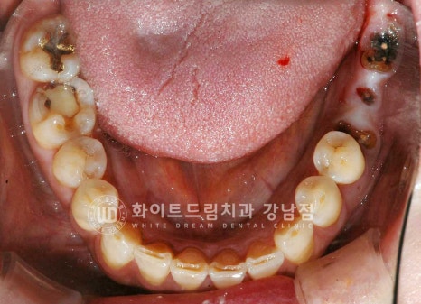 신경치료 후 크라운을 해야 하는 이유 / 크라운을 안 해 부러진 치아 임플란트 치료 case 관련 이미지 19