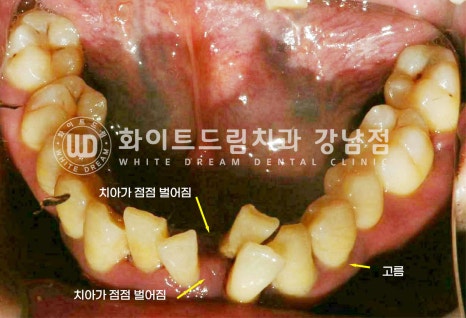 40대 전체임플란트 / 디지털스캔바디를 이용한 전체 임플란트 치료 사례 (Feat. 치주염) 관련 이미지 6