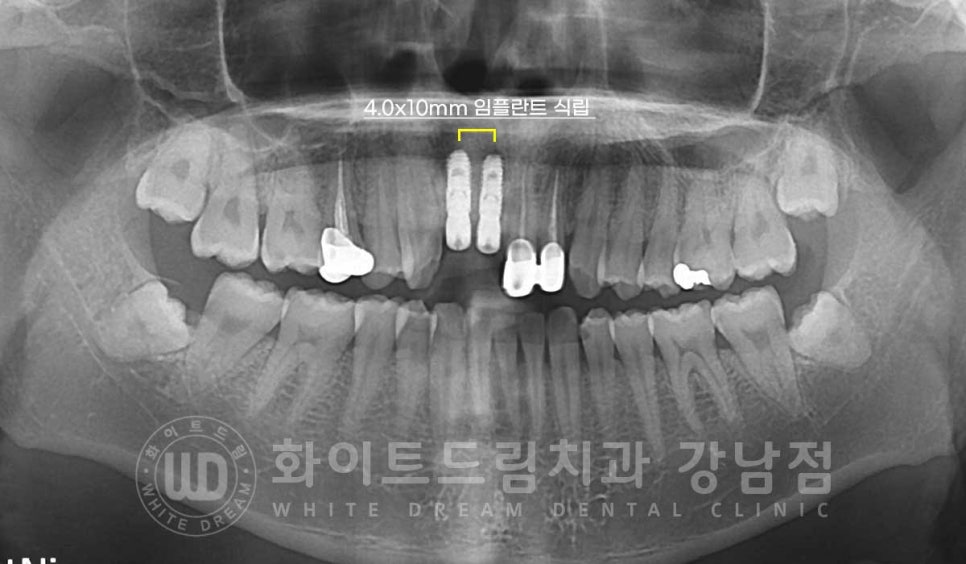 앞니 임플란트 사례 "예전에 심은 임플란트를 뺐어요. 재수술 가능할까요?" 관련 이미지 6