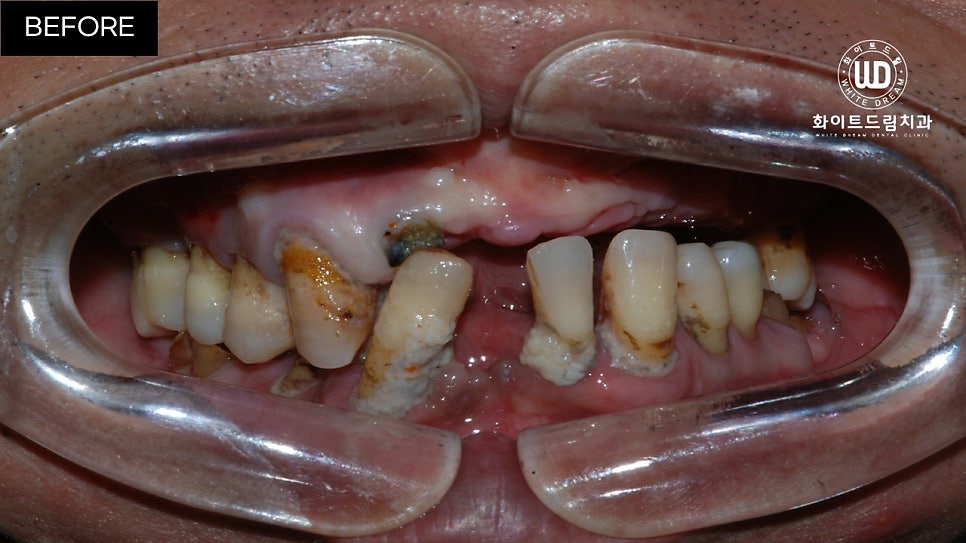 전체임플란트 식립 및 임플란트뼈이식 후기 관련 이미지 11