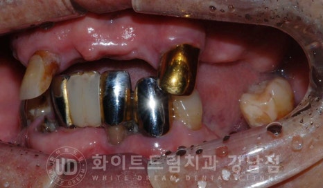 전체 임플란트 치료 기간과 내원 횟수는? "치과에 자주 가기 어려워요." 관련 이미지 28