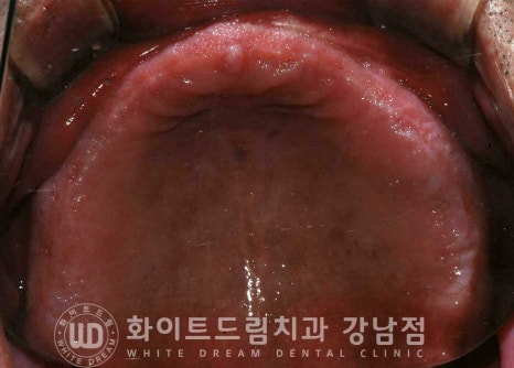 전체 임플란트 치료 기간과 수술 후 나타나는 변화는? 관련 이미지 14