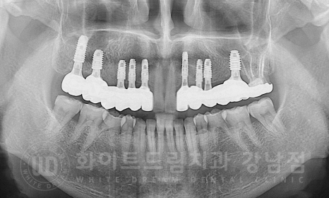 강남역 치과브릿지 "브릿지가 흔들려요" 흔들리는 브릿지 치료는? 관련 이미지 12