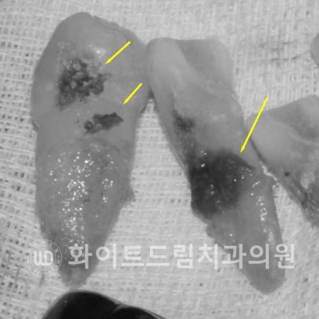 강남역전체임플란트 / 발치 후 즉시 식립, 무조건 누구나 3개월로 끝낼 수 있는 것일까? 강남역화이트드림치과 관련 이미지 9
