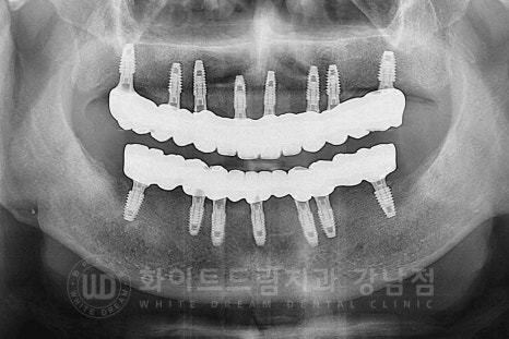 전체임플란트 치료기간 / "전체 임플란트 6개월 완성" (feat. 부분 틀니 10년 사용) 관련 이미지 6