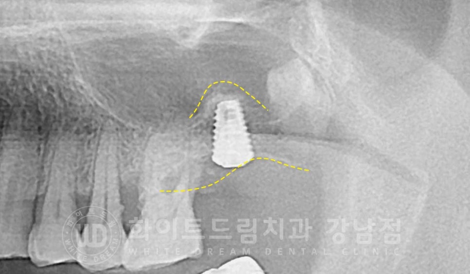 [흔들리는 어금니크라운] 흔들리고 냄새나는 오래된 크라운, 원인은? 관련 이미지 10