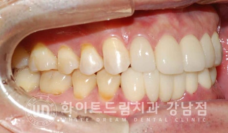 강남역 결손치 "앞니 두 개가 없고, 벌어졌어요" 결손치 치료 방법 관련 이미지 11
