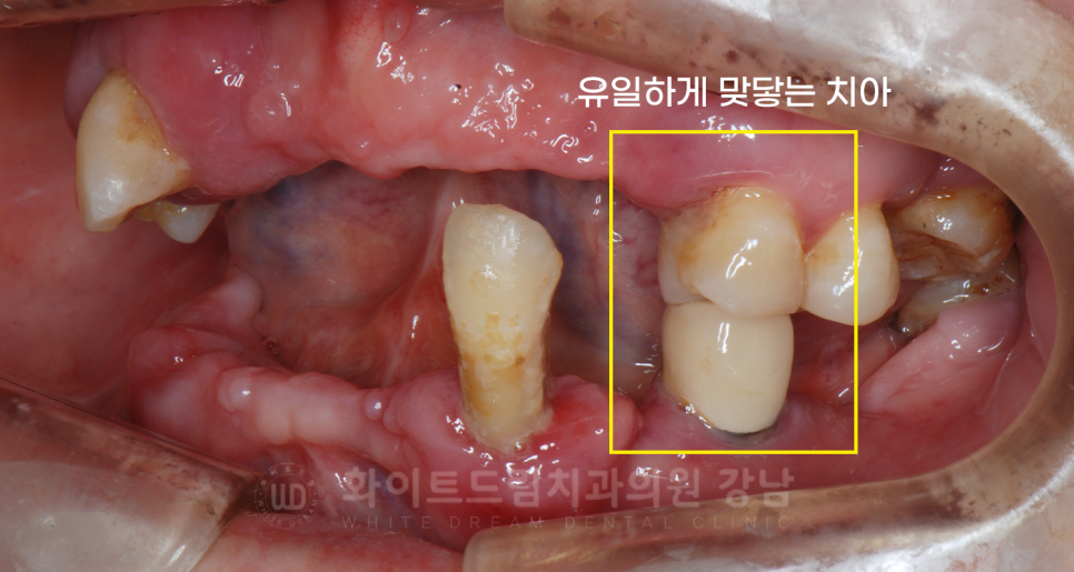 강남역 임플란트 치과 "틀니가 안 맞아서 불편해요" 틀니 → 전체 임플란트로! 관련 이미지 9