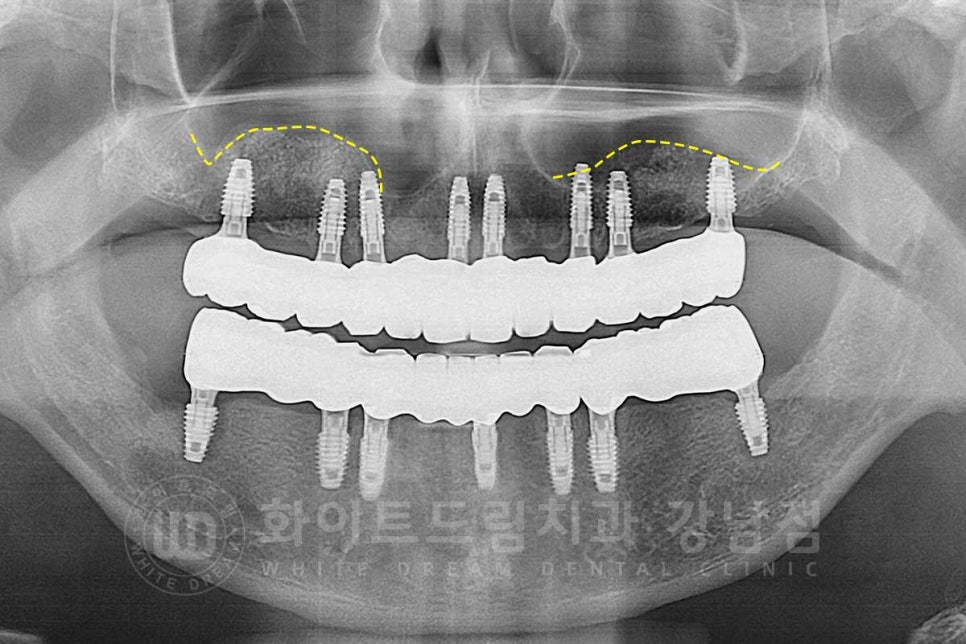 상악동거상술 잘하는치과, 강남역 화이트드림치과 상악동 함기화로 인한 거상술 치료 리뷰 관련 이미지 14