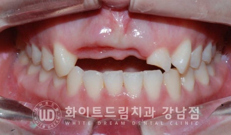 앞니 빠짐 임플란트 / 사고로 인한 앞니 탈구. 앞니 임플란트 치료는? 관련 이미지 17