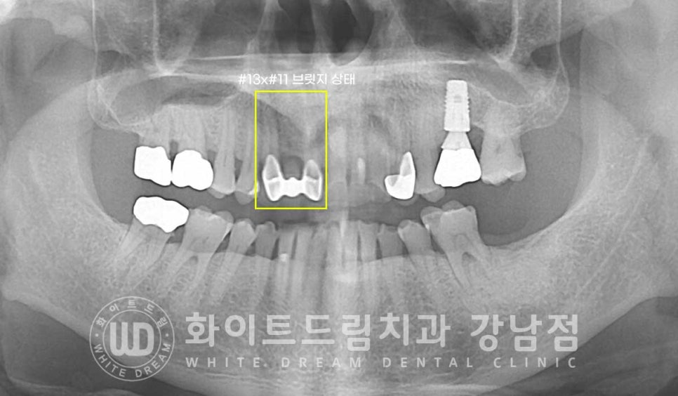 앞니 충치 라미네이트 치료 / "옆 크라운과 치아 색상을 맞추고 싶어요" 관련 이미지 4