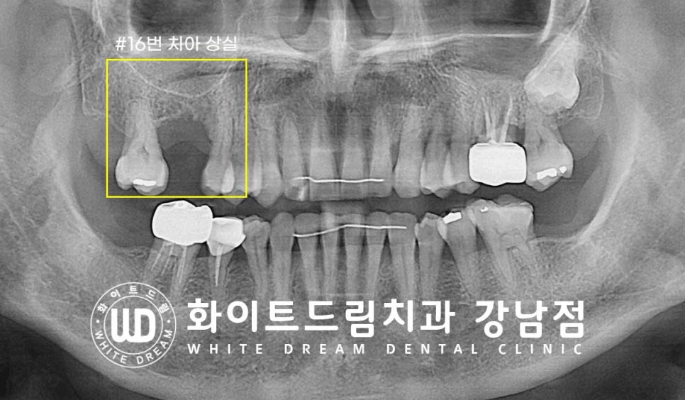 상악 어금니 임플란트 치료 시 동반되는 "상악동 거상술" 이란? 관련 이미지 2