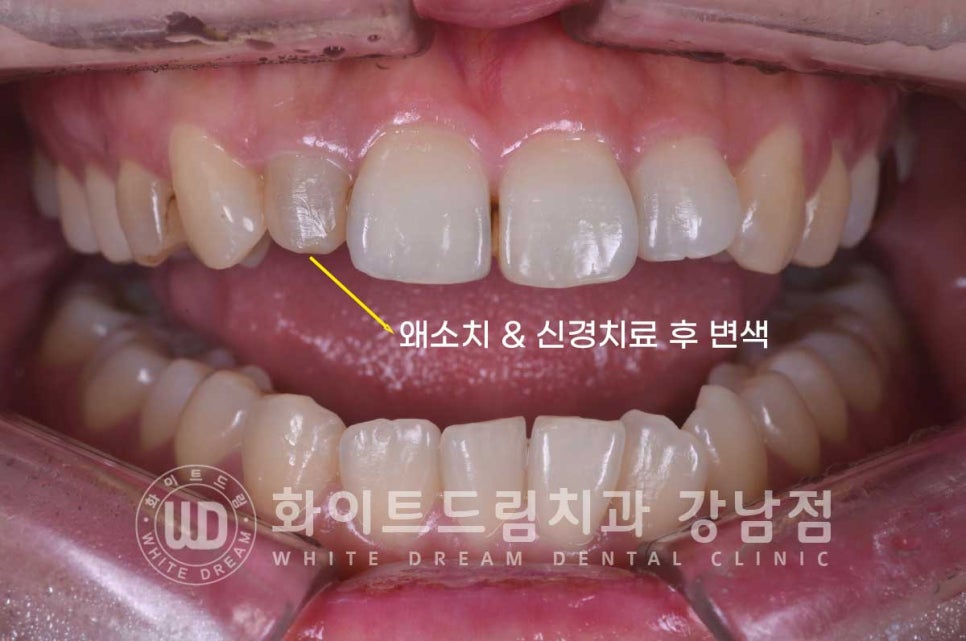신경치료 후 크라운을 씌워야 하는 이유 & 신경치료 후 변색 치료 Case 리뷰 관련 이미지 6