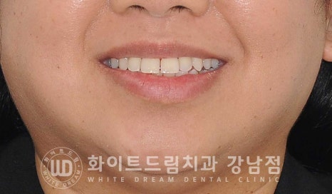 앞니 뻐드러짐 라미네이트 "뻐드러지고 벌어진 앞니" 당일 라미네이트 치료 case 관련 이미지 1