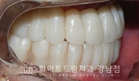 전체 임플란트 치료 기간과 수술 후 나타나는 변화는? 관련 이미지 13