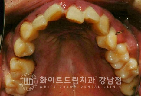 40대 전체임플란트 / 디지털스캔바디를 이용한 전체 임플란트 치료 사례 (Feat. 치주염) 관련 이미지 19