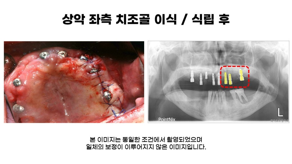 40대임플란트식립후기 및 어금니임플란트 가격, 종류 알아보기 위해 관련 이미지 7