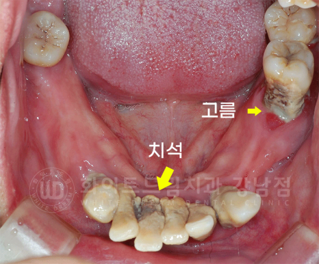 강남역 전체임플란트 치과 "치아가 심하게 흔들려요." 심한 치주염 임플란트 치료 관련 이미지 17