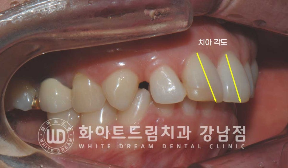 앞니 원데이라미네이트, 뻐드러지고 벌어진 앞니! 당일 치료 ok 관련 이미지 10