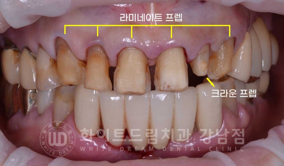 중년 앞니라미네이트 / 노화로 마모되고 누렇게 변한 치아, 어떻게 치료할까? 관련 이미지 12