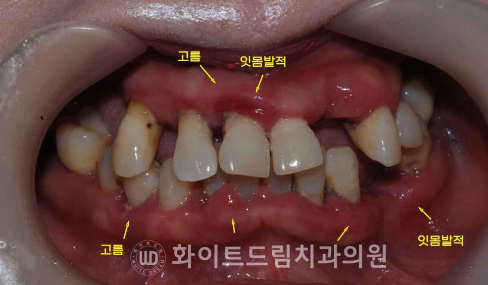 서울전체임플란트 / "경상도에서 왔어요." 치주염으로 인한 앞니 돌출 치료 (+서울전체임플란트 내원 횟수는?) 관련 이미지 3