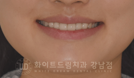 강남 벌어진앞니 교정 / "심하게 벌어진 치아, 어떻게?" 부분교정 + 라미네이트로 개선! 관련 이미지 15