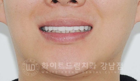 틀어진 치아 라미네이트, 틀어지고 색이 다른 앞니가 고민이에요. 관련 이미지 4