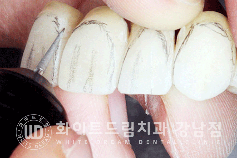 강남역 앞니라미네이트 "틀어진 토끼 앞니 빠르게 개선" 강남역 라미네이트 치과 관련 이미지 9