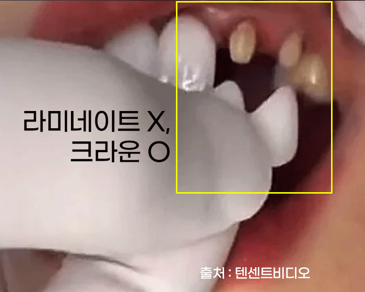 강남역 인근 치과 / 테트라사이클린(tetracycline) 치아 변색 / 라미네이트로 개선! 관련 이미지 8